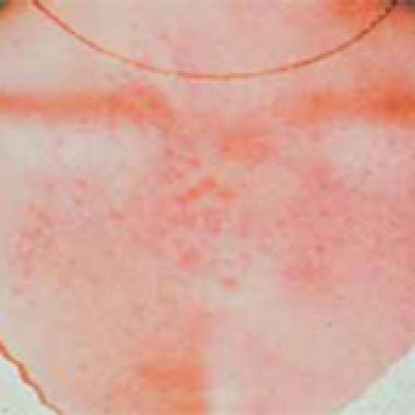 FOTODERMATOSIS