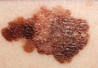 MELANOMA