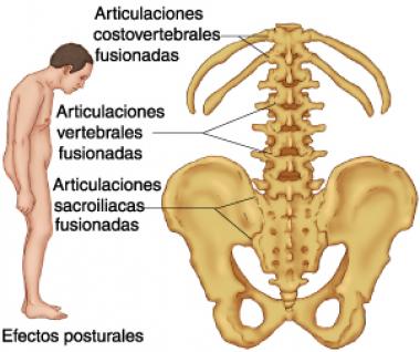 ESPONDILITIS ANQUILOSANTE