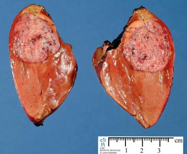 HEPATOBLASTOMA