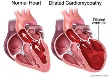 cardiomiopatía alcohólica