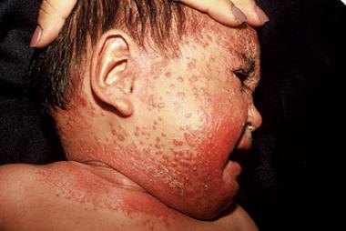 DERMATITIS EXFOLIATIVA