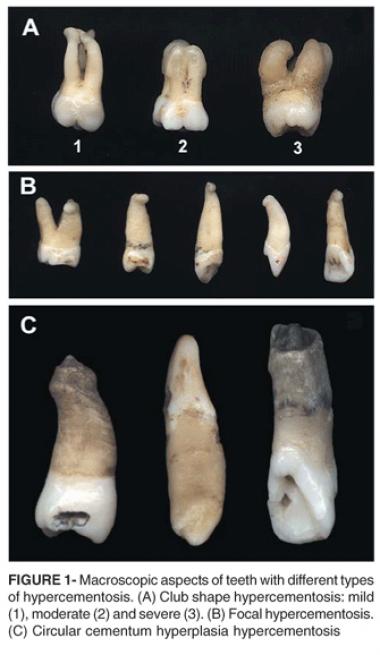 HIPERCEMENTOSIS