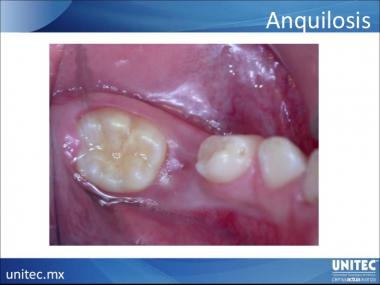 ANQUILOSIS DENTAL