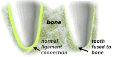 ANQUILOSIS DENTAL