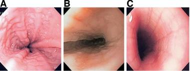 ESOFAGITIS EOSINOFÍLICA