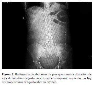 HIPERPERISTALSIS