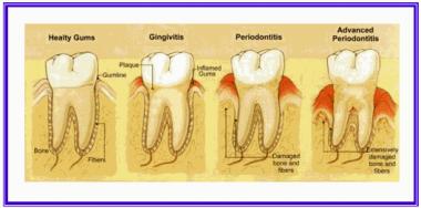 PERIODONTITIS