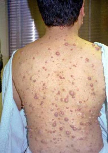 NEUROFIBROMATOSIS