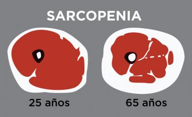 SARCOPENIA