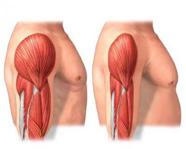 SARCOPENIA