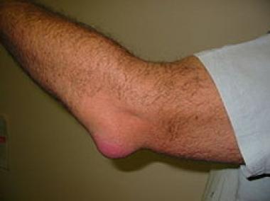 BURSITIS