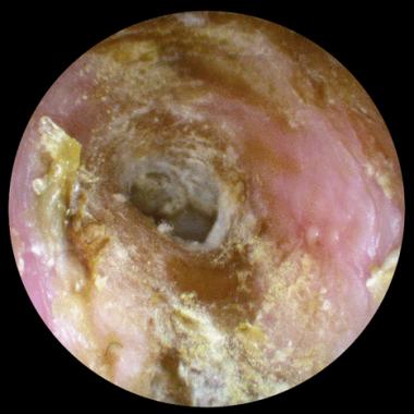 síntomas de otomicosis