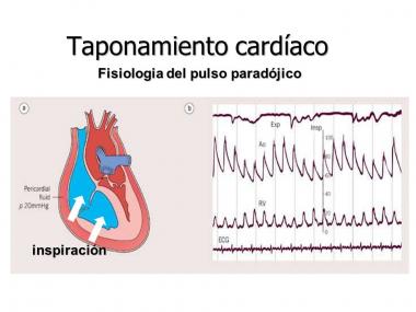 PULSO PARADÓJICO