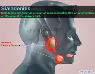 SIALADENITIS