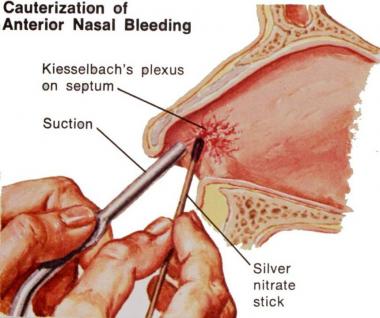 EPISTAXIS ANTERIOR