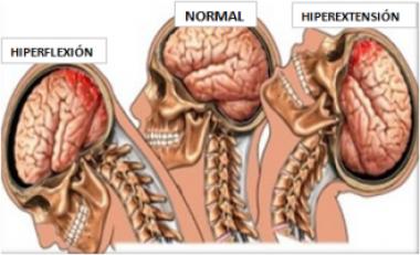 HIPEREXTENSIÓN CERVICAL