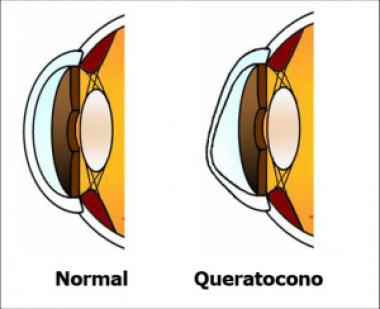 QUERATOCONO