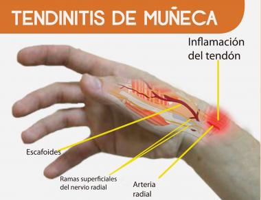 TENDINITIS