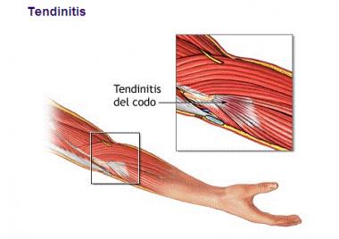 TENDINITIS