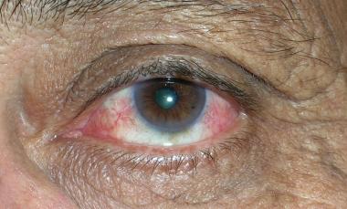 CONJUNTIVITIS ACTÍNICA