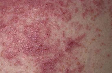 DERMATITIS HERPETIFORME