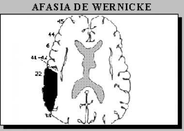AFASIA DE WERNICKE
