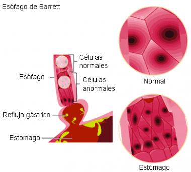 ESÓFAGO DE BARRETT