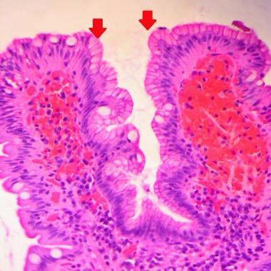 DUODENITIS