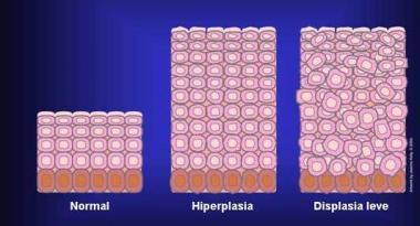 DISPLASIA CELULAR