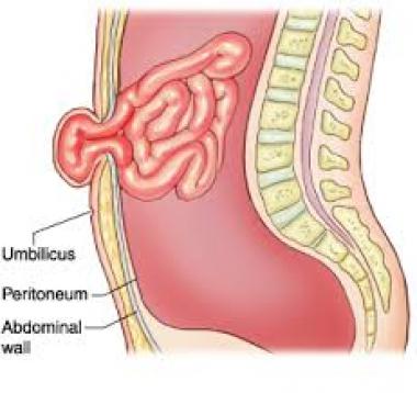 HERNIA UMBILICAL