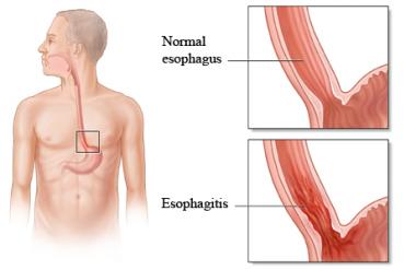 ESOFAGITIS