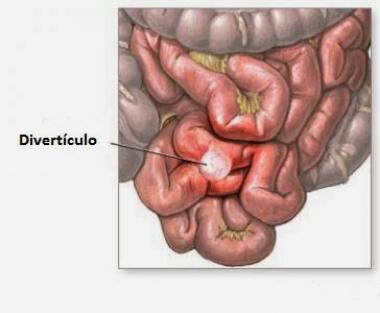 ENFERMEDAD DIVERTICULAR DEL INTESTINO