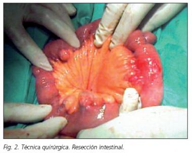 DIVERTICULOSIS INTESTINAL