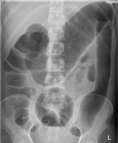 MEGACOLON