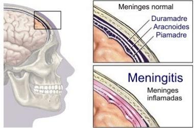 MENINGITIS MENINGOCÓCICA