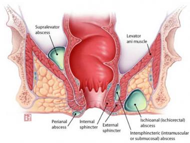 ABSCESO RECTAL