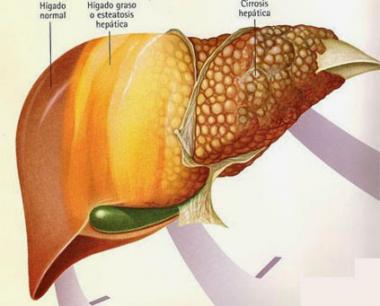 ESCLEROSIS HEPÁTICA