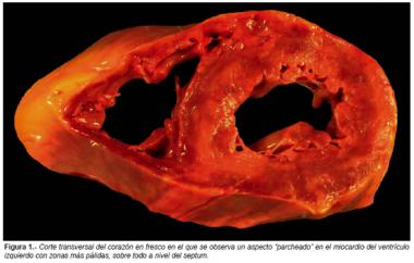 MIOCARDITIS