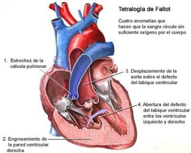 MIOCARDIOPATÍA ESPONGIFORME