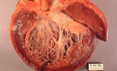 MIOCARDIOPATÍA ESPONGIFORME