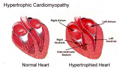 MIOCARDIOPATÍA HIPERTRÓFICA