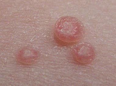 MOLUSCO CONTAGIOSO