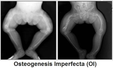 OSTEOGÉNESIS IMPERFECTA