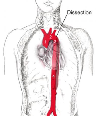 DISECCIÓN DE AORTA