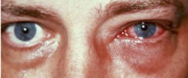 QUERATOCONJUNTIVITIS