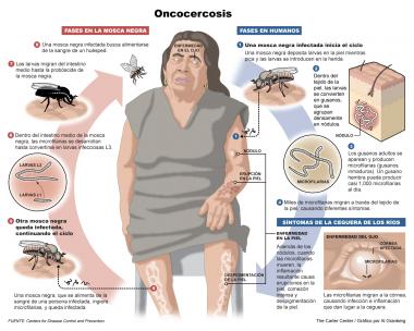 ONCOCERCOSIS