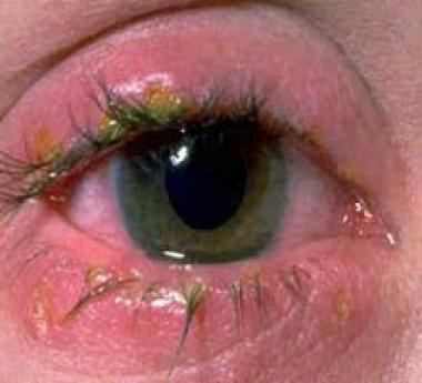 CONJUNTIVITIS BACTERIANA