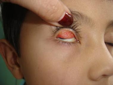 QUERATOCONJUNTIVITIS VERNAL