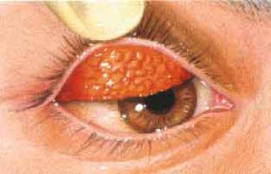 CONJUNTIVITIS LEÑOSA